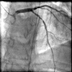 An example of a coronary angiogram, the imaging method used to assess the severity of coronary artery disease in patients enrolled in the BARI 2D clinical trial.